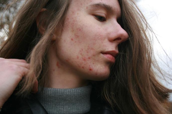 Gezicht van een persoon met acne