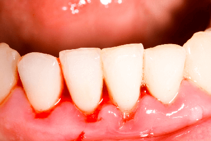 gingivitis symptoms