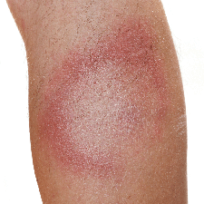 erythema migrans