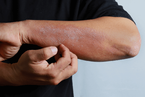eczéma