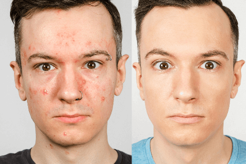 acné causes