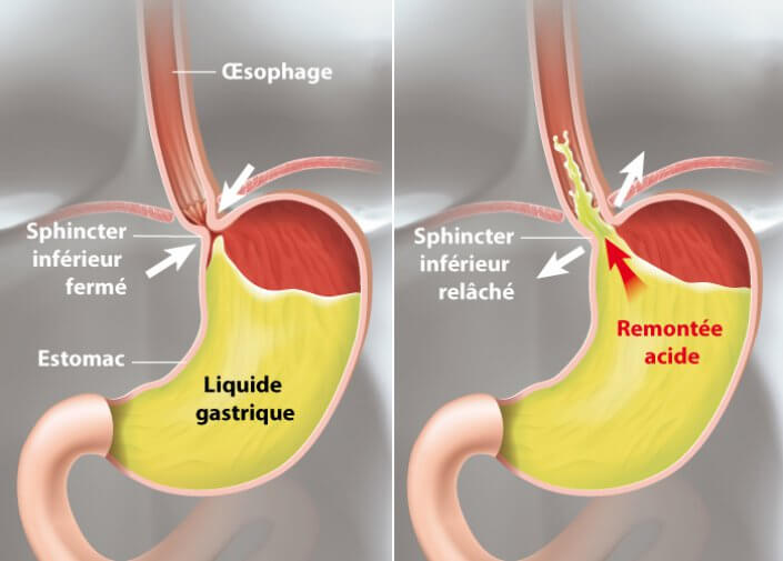 Comment traiter le reflux gastrique œsophagien ?
