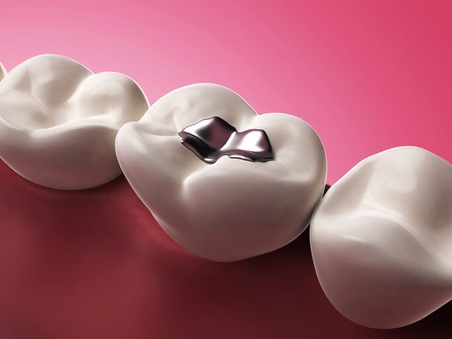amalgames dentaires illustration