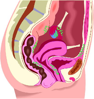 estomac crampes ulcère solutions