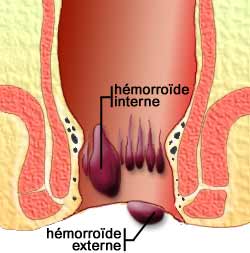 hemorroide-anatomie-fr